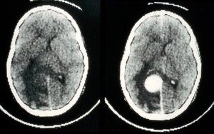 view CT scan; brain cancer (meningioma)