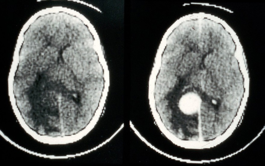 CT scan; brain cancer (meningioma)