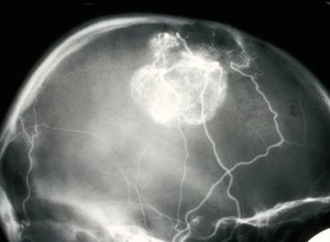 view Cerebral angiogram; brain cancer (meningioma)