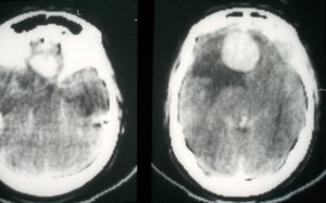 view CT scan; brain cancer (meningioma)