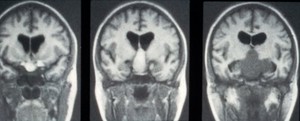 view MRI scan; brain cancer (teratoma)