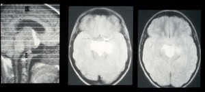 view MRI scan; brain cancer (teratoma)