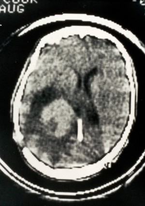 view CT scan; brain tumour (papilloma), choroid plexus