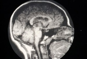 view Cyst, third ventricle