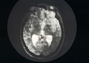 view Cyst, third ventricle