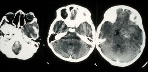 view CT scan; eye cancer (rhabdomyosarcoma), orbit