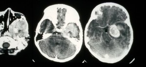 view CT scan; eye cancer (rhabdomyosarcoma), orbit