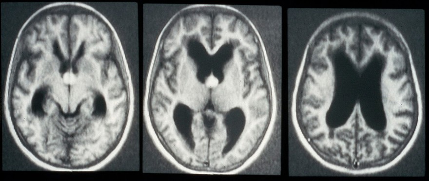 Cyst, colloid