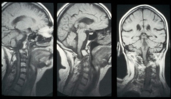 Cord compression, odontoid erosion