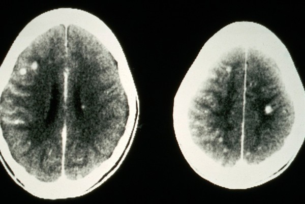 Tuberculomas