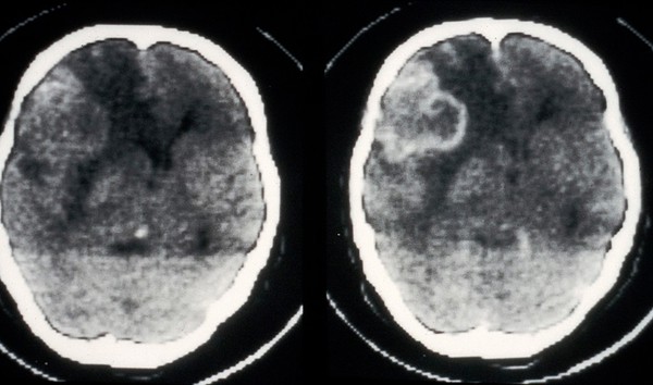 Tuberculosis abscesses, confluent