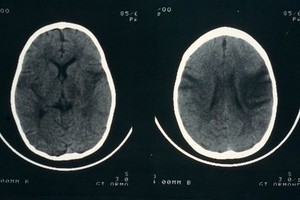 view Herpes encephalitis, progression