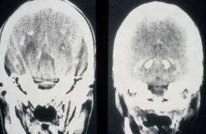 view Hypoparathyroidism