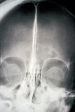 view Hypoparathyroidism