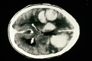 view CT scan; brain metastases from unknown primary