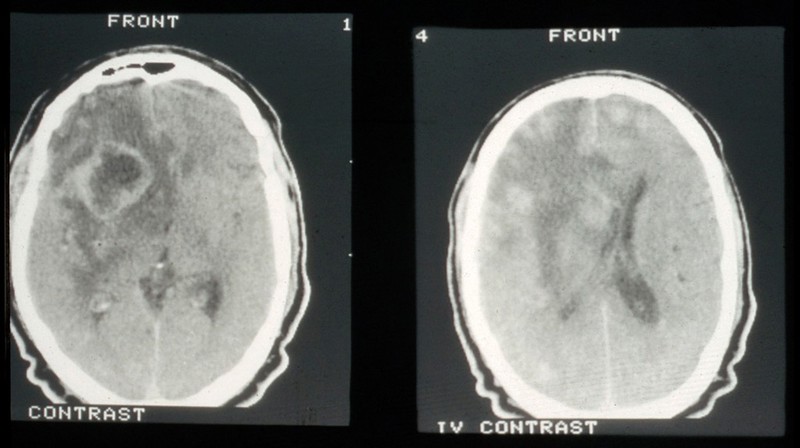 CT scan; brain metastasis from skin cancer (melanoma) | Wellcome Collection