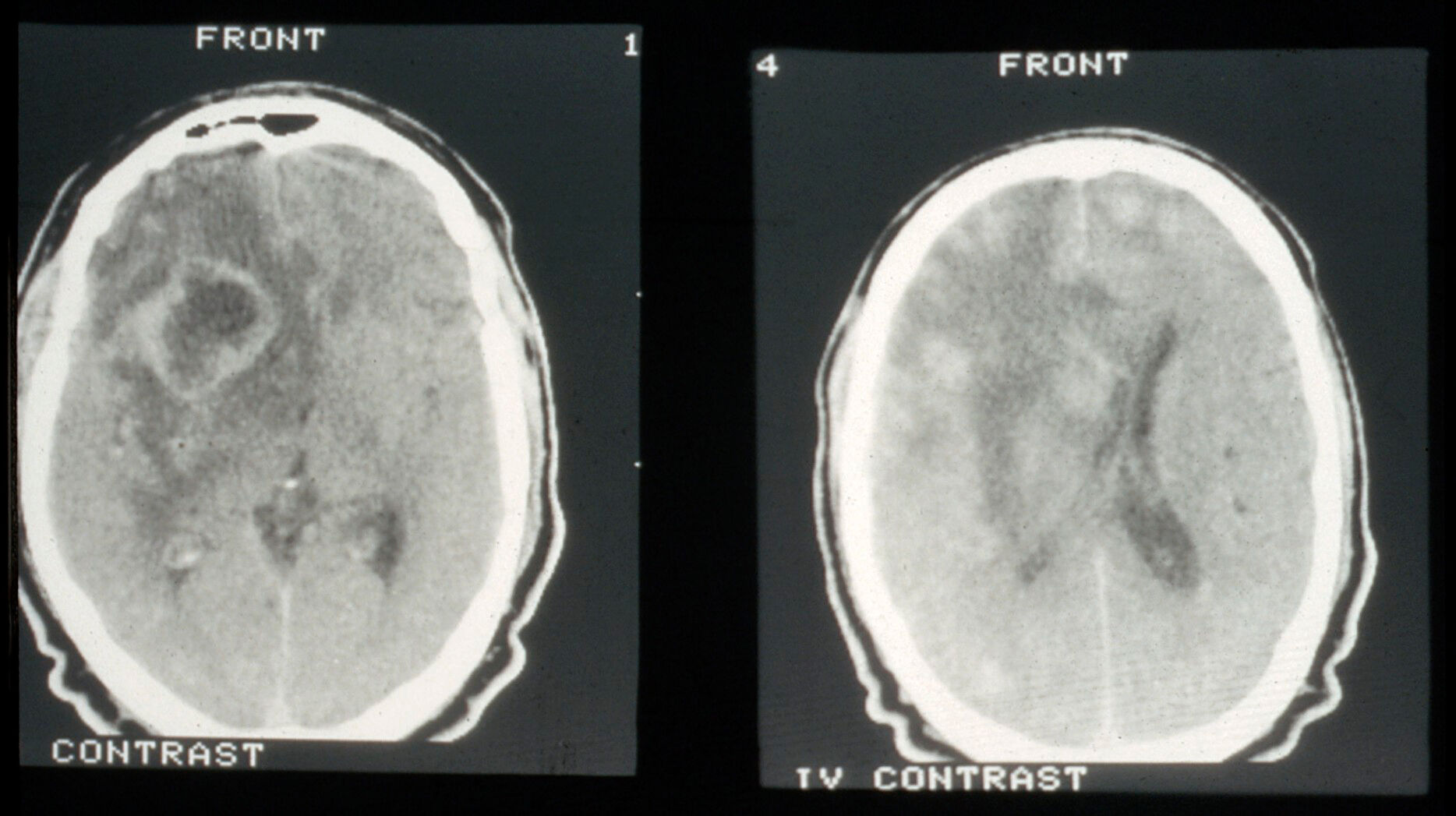 Melanoma Ct Scan With Contrast - ct scan machine