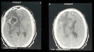 view CT scan; brain metastasis from skin cancer (melanoma)