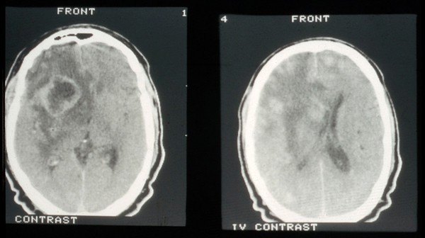 CT scan; brain metastasis from skin cancer (melanoma)