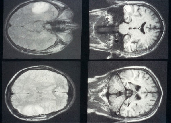 MRI scan; brain metastases from skin cancer (melanoma)