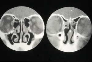 view Lachrymal glands, enlargement