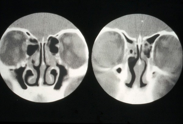 Lachrymal glands, enlargement