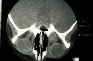 view CT scan; bilateral optic nerve cancer (glioma)