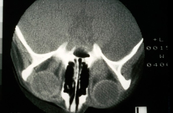 CT scan; bilateral optic nerve cancer (glioma)