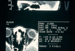 view Normal lachrymal gland