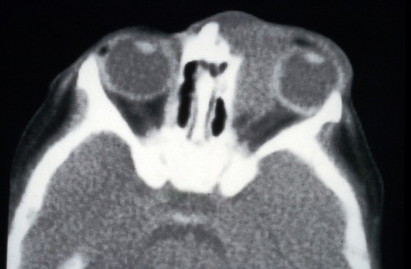 CT scan; eye cancer (rhabdomyosarcoma), orbit