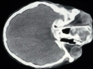 view Dysplasia, fibrous