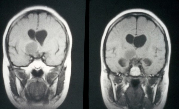 Craniopharyngioma