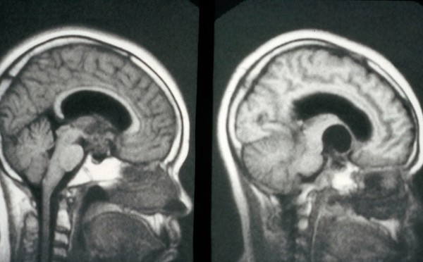 Craniopharyngioma