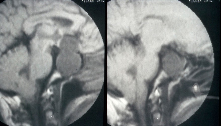 MRI scan; cancer of the pituitary gland
