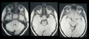 view MRI scan; cancer of the pituitary gland