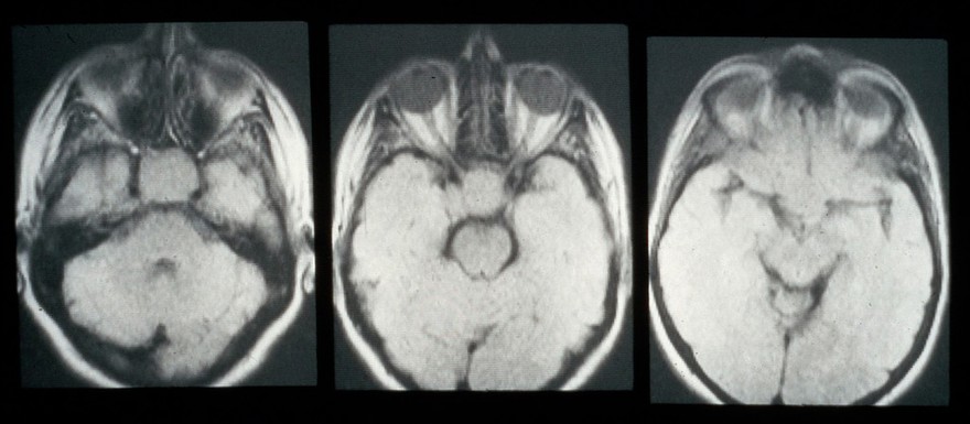 MRI scan; cancer of the pituitary gland