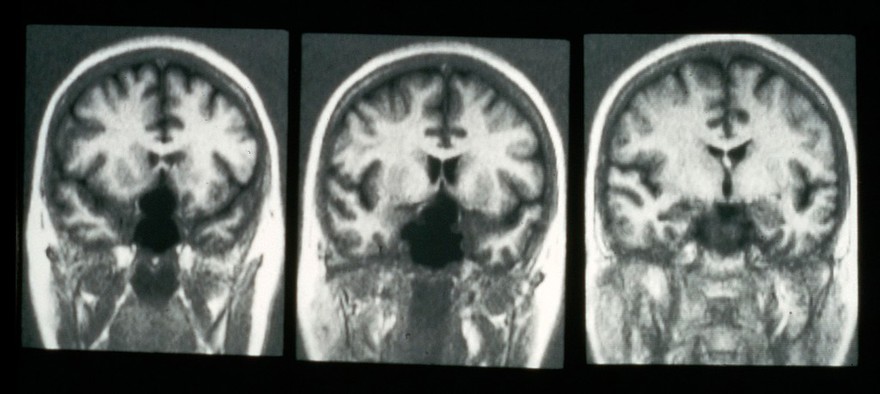 MRI scan; cancer of the pituitary gland