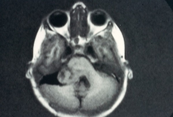 MRI scan; brain cancer (glioma), brain stem