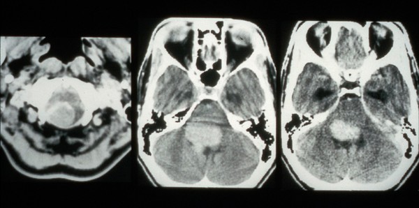 CT scan; brain cancer (glioma), brain stem