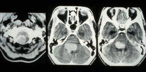 view CT scan; brain cancer (glioma), brain stem