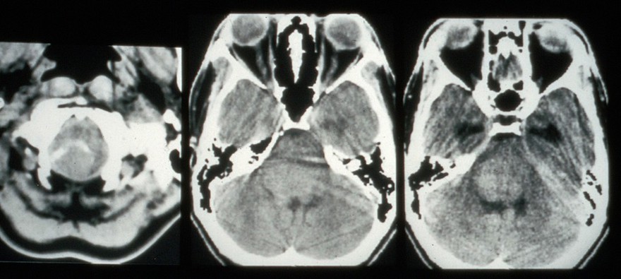 CT scan; brain cancer (glioma), brain stem