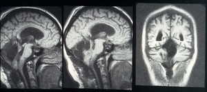 view MRI scan; brain cancer (astrocytoma)