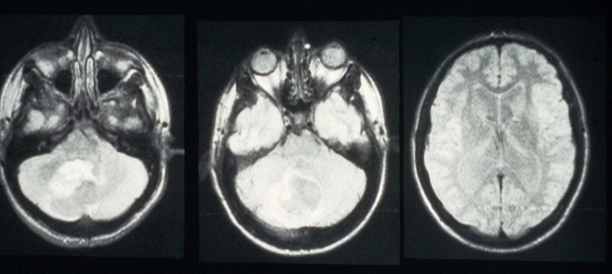 MRI scan; brain cancer (astrocytoma)