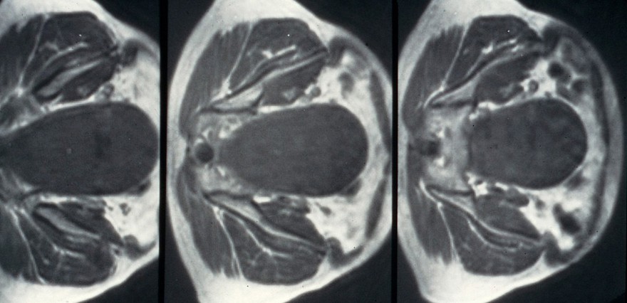 Meningocoele, anterior sacral