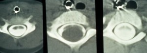 view Cyst, cervical neurenteric