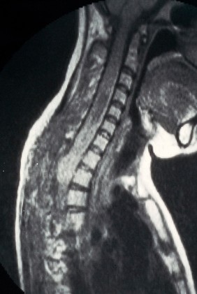 MRI scan; spinal cord cancer, cervical, cystic change