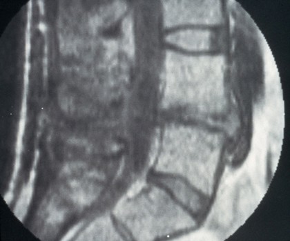 Disc protrusion, lumbar 4/5