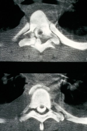 view Fracture dislocation, dorsal vertebra