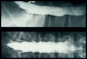 view Normal spinal canal