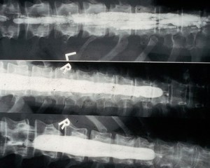 view Normal spinal canal